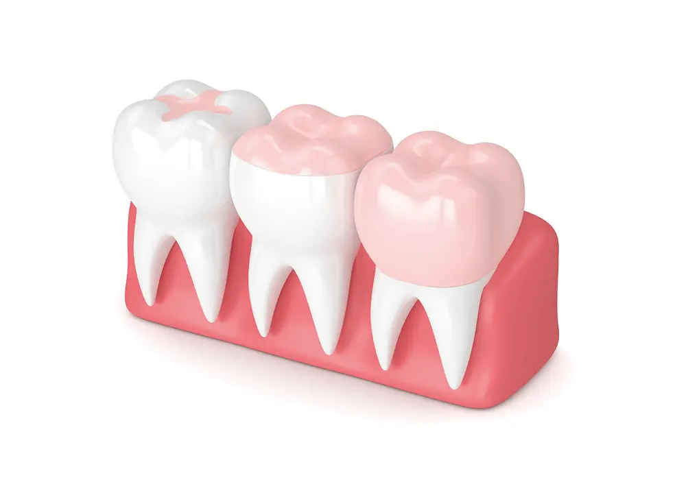 Inlay Onlay Porzellanfüllung Behandlung